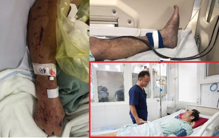 Người đàn ông 61 tuổi ở Hưng Yên bị sốc nhiễm khuẩn, viêm màng não sau khi chế biến thịt lợn sống